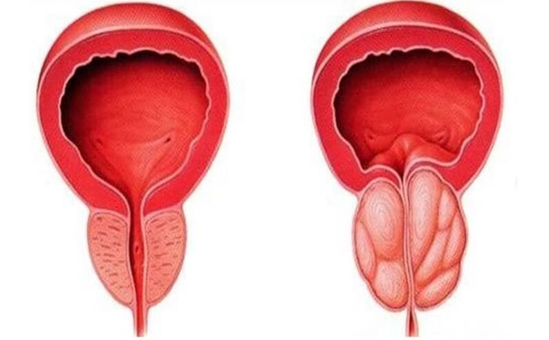 gezonde en ontstoken prostaat met prostatitis