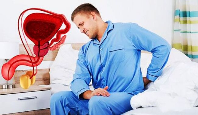 lage rugpijn als gevolg van prostatitis