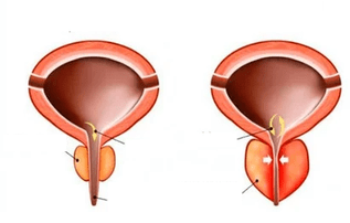 wat is acute prostatitis