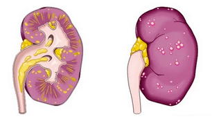 wat veroorzaakt acute prostatitis