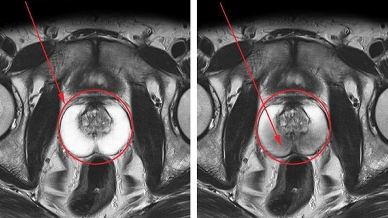 een gezonde en ontstoken prostaat met chronische prostatitis