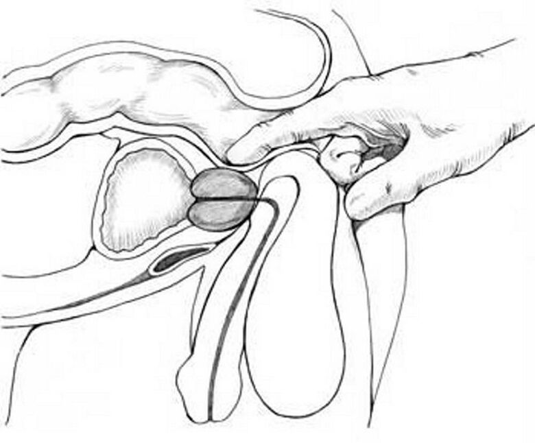 prostaatmassage voor chronische prostatitis