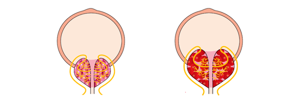 gezonde en ontstoken prostaat met prostatitis